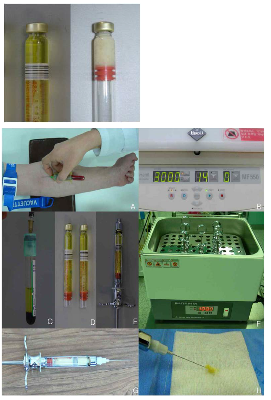 자가혈장 이식물질 제조 벙법.