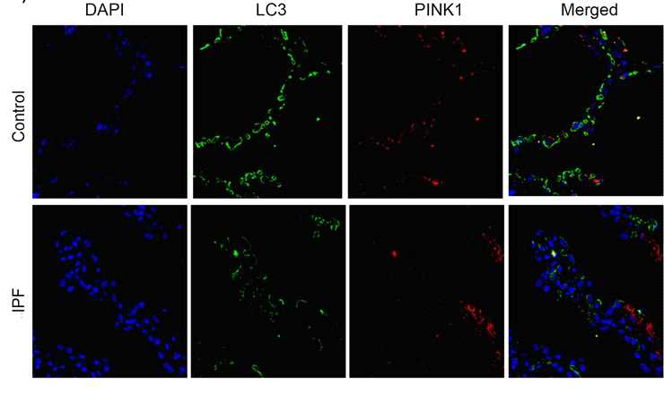 특발성 폐섬유증 환자의 폐조직에서 LC3B와 PINK1의 면역형광염색