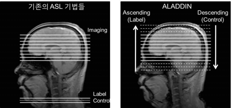 기존의 ASL 기법들(왼쪽)과 단면간 관 류영상 기법(오른쪽)을 도식적으로 표시한 그 림