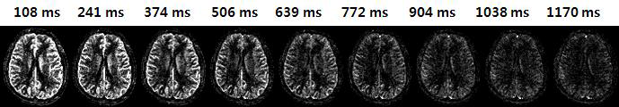 정상인의 뇌에서 다중위상 단면간 관류영상 기법으로 얻은 역동적 관류강조영 상(PWI). 모세혈관의 신호는 급격히 감소하지만 혈관의 신호는 상대적으로 천천히 사 라짐
