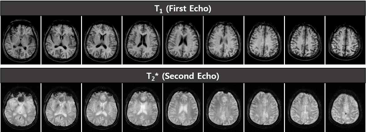 듀얼에코기법과 k-space 데이터 획득 순서 재조정 방법을 접목시켜 동시에 획득한 3D T1과 T2* 영상 (7번째 - 15번째 단면) 총 획득 시간 = 2분 22초