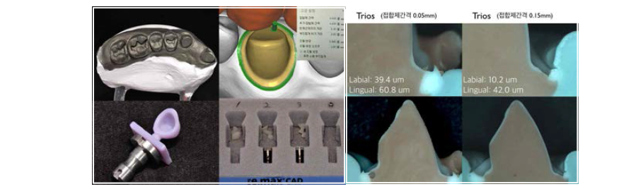 금속팬텀을 대상으로 시행한 마진부위 정확도 평가 및 내면 적합수치 보정 과정