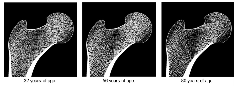 퇴행성 골 재형성 전산모사 결과