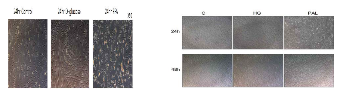 정상 HFLS 세포에 고혈당, palmitic acid 처리 후 24시간, 48시간 후 형태학적 모습