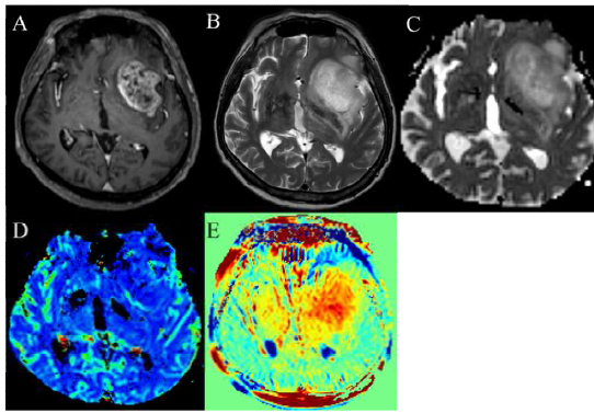 WHO grade IV 뇌종양의 ADC 영상(C), rCBV 영상(D),및 아미드 양성자 전이 영상(E). 아미드 양성자 전이 신호가 2.66%로 고등급 종양에 합당함.