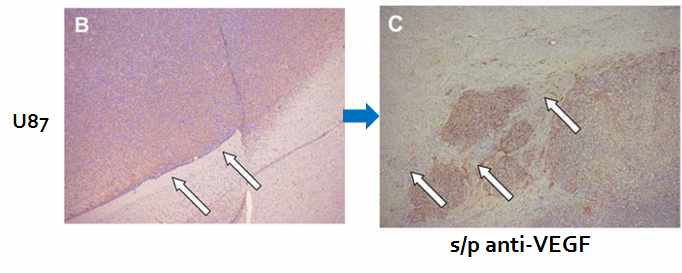 U87 세포 주를 이식받은 마우스의 뇌에서 경계가 좋은 교모세포종이 발생하였으나(좌측) 항 혈관내피성장인자를 치료한 모델에서는 종양세포가 주변으로 침윤하는 표현형으로 변화함(de Groot et al. Neuro Oncol 2010)