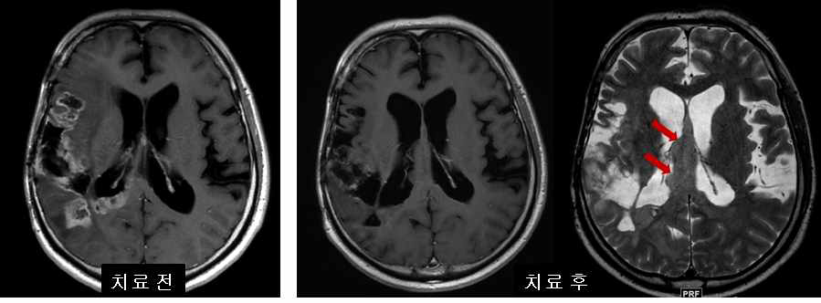 재발한 교모세포종 환자의 증례이다. Bevacizumab 치료 전(좌측) 조영증강 T1 강조영상에서 보이던 조영증강 병변이 치료 후(가운데) 매우 감소함. 하지만 T2 강조영상(우측)에서는 조영증강이 되지 않는 고신호 병변이 septum pellucidum을 따라서 자라고 있는 것(화살표)을 확인할 수 있으며 이를 위반응이라고 함.