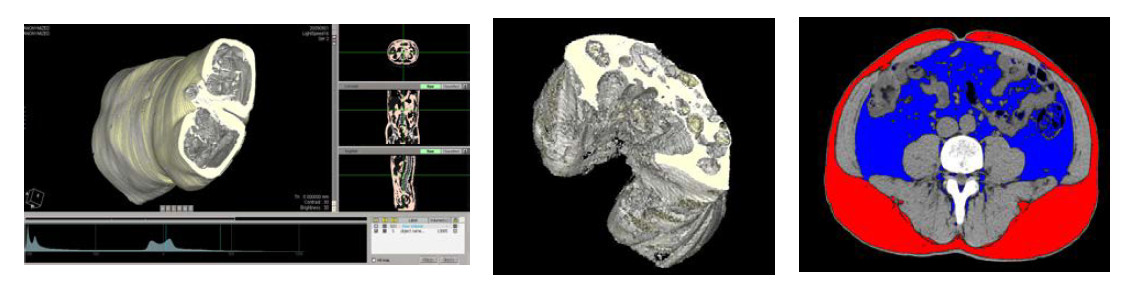 Measurement of visceral fat area and 3D volume quantification process