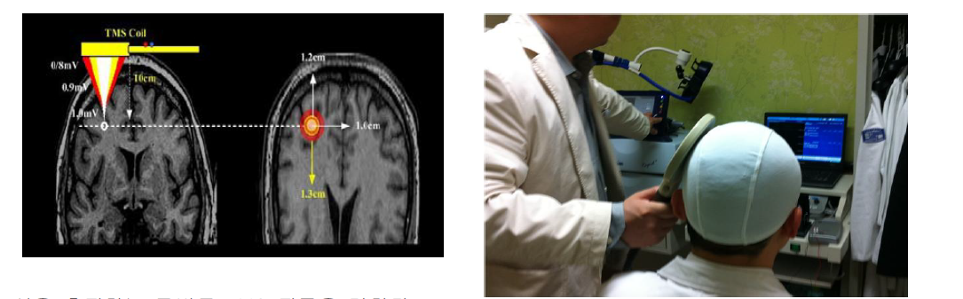 TMS 적용의 기본개념 및 시행 모습