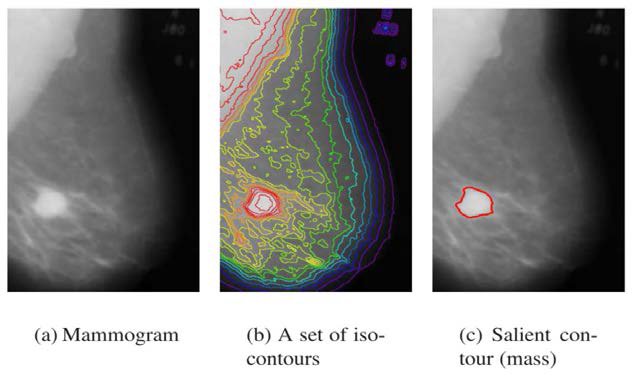 Salient contour (mass) extraction from mammogram image