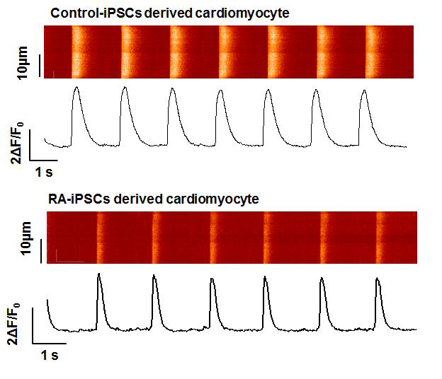 비정상 심장칼슘신호전달 (RA-iPSC-CM)