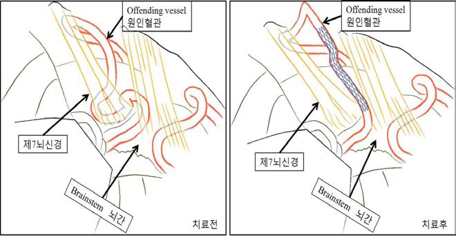 뇌신경을 압박하는 뇌혈관에 스텐트를 삽입하여 뇌혈관의 주행경로를 바꾸어 뇌신경을 감압함.