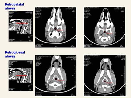 토끼의 상기도의 midline 단면. 경구개의 하단면을 retropalatal level로 정의하고, hyoid bone의 상단면을 retrglossal level로 정의함