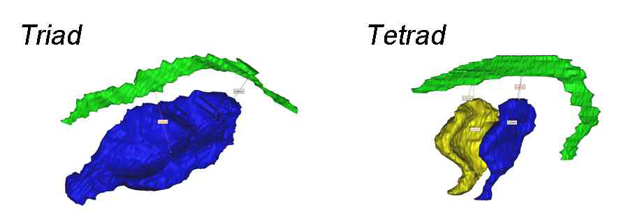 망막 주변부의 막대세포 리본연접의 연접후성분이 triad인 경우와 tetrad인 경우 short & long distance 측정의 예