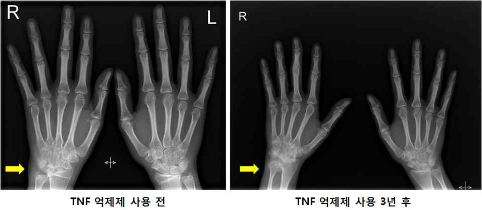 TNF 억제제 치료 후에도 골파괴 지속된 환자 예 (서울성모병원)