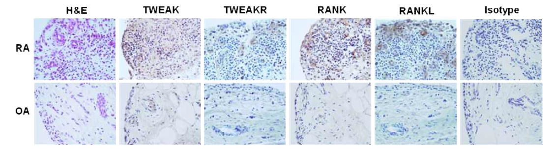 류마티스관절염 환자의 활막조직에서 TWEAK 및 RANKL의 발현 증가
