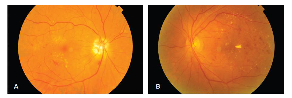 (A) 비증식성 당뇨병성 망막병증의 안저 사진, (B) 황반 주변의 미세동맥류, 점상출혈 및 경성 삼출물이 관찰됨