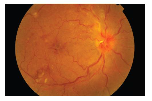 증식성 당뇨병성 망막병증의 안저 사진. 시신경유두 부위에 신생혈관 증식과 섬유화 소견이 관찰됨