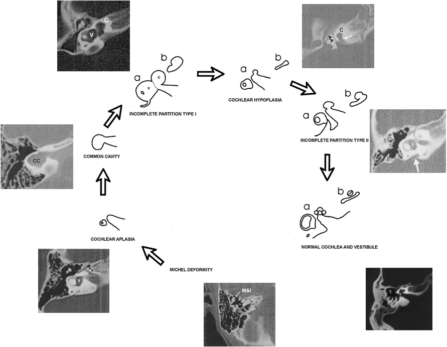내이의 발달 정도를 기준으로 분류한 골성 미로 이형성 모식도와 전산화 단층 촬영(CT, Computerized Tomography) 결과.