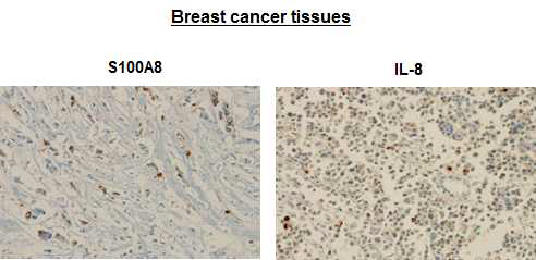 유방암 환자 조직에서 S100A8 및 IL-8 발현을 immunohistochemistry로 확인함.