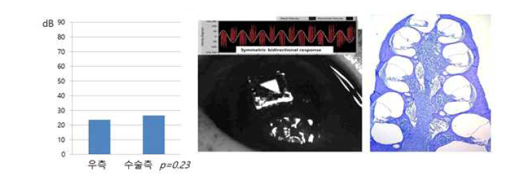 급성기 모델. No ABR change, VFT : symmetric, No hydrops