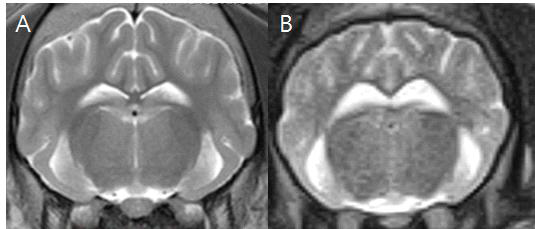 Interthalamic adhesion부위에서의 T2w 강조 영상 3T(A), 0.3T(B)