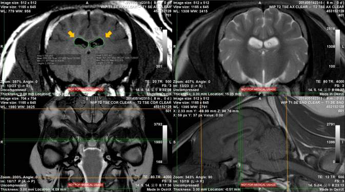 Lateral ventricle을 세 방향(transverse, dorsal, sagittal)에서 tracing하는 과정의 한 단면