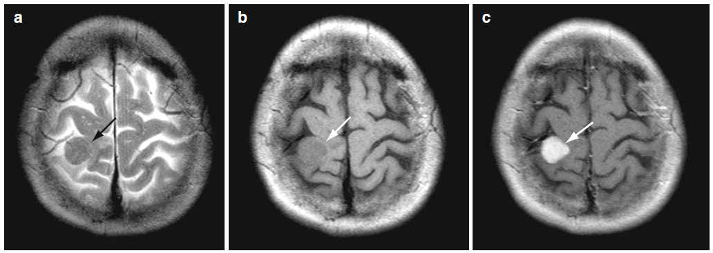 뇌종양 환자의 T2 강조(a), T1 강조(b), T1 강조 조영증강(c) 영상