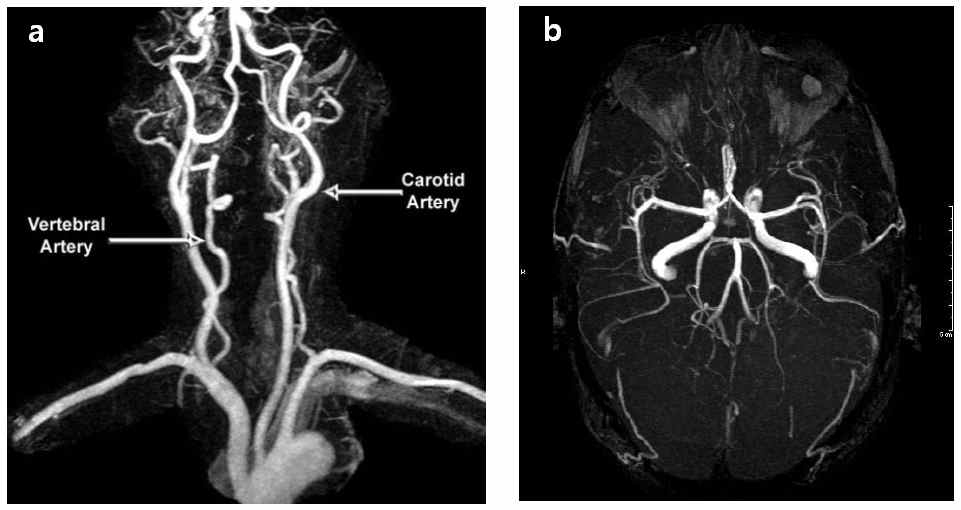 3D로 재구성된 TOF MRA 영상. 두개 내로 유입되는 경부 혈관(a)과 뇌혈관(b).