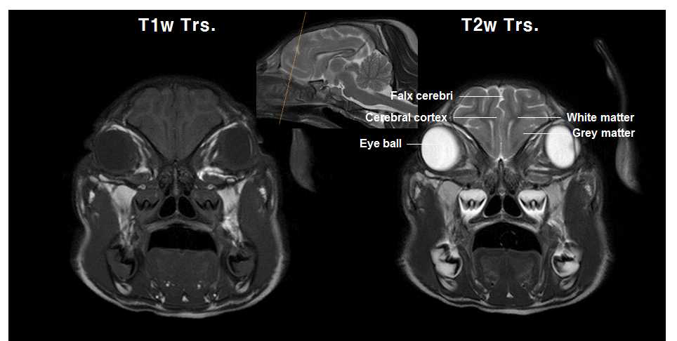 전두엽 레벨의 T1강조 및 T2강조 영상