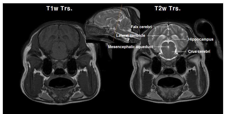 중뇌수도관 레벨의 T1강조 및 T2강조 영상