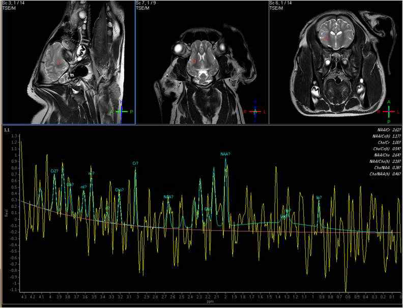 측두엽의 백색질을 ROI로 설정한 MR spectroscopy