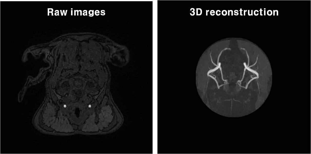 TOF raw image(좌)를 바탕으로 재구성된 뇌혈관 영상(우)