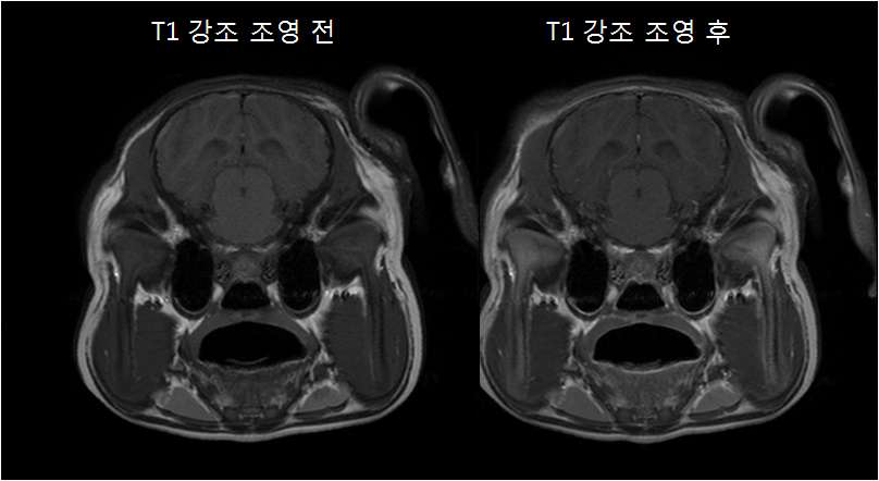 시상 레벨의 조영 전(좌)과 조영 후(우) T1 강조 영상
