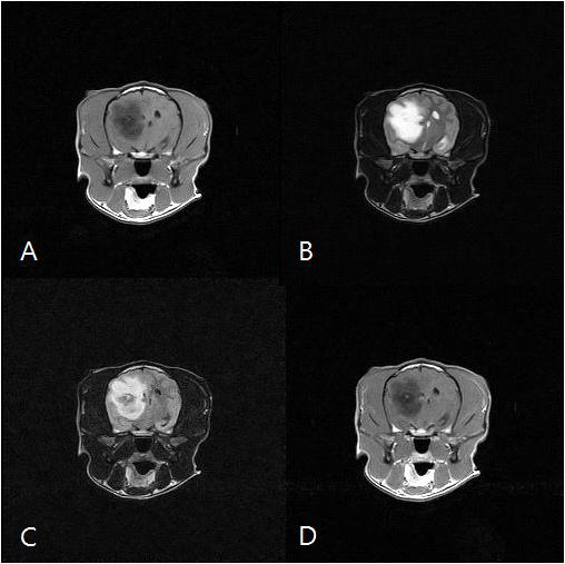 달봉 MRI영상 T1강조(A), T2강조(B), FLAIR(C), T1강조조영증강(D)