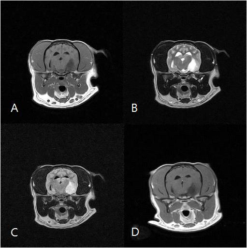 간지 MRI영상 T1강조(A), T2강조(B), FLAIR(C), T1강조조영증강(D)
