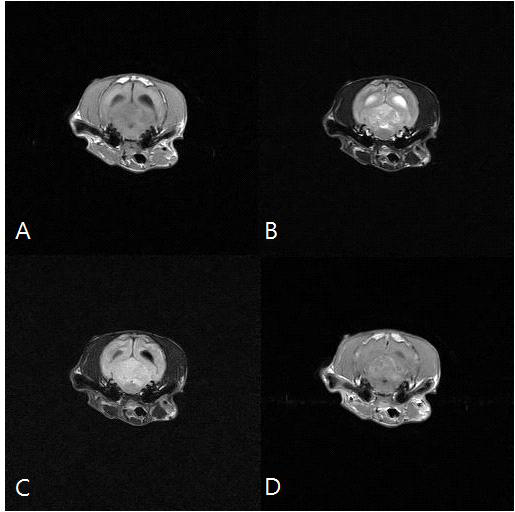 아롱 MRI영상 T1강조(A), T2강조(B), FLAIR(C), T1강조조영증강(D)