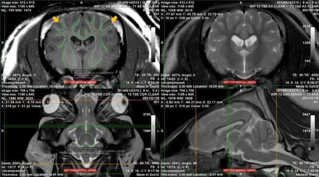 White matter를 세 방향(transverse, dorsal, sagittal)에서 tracing하는 과정의 한 단면