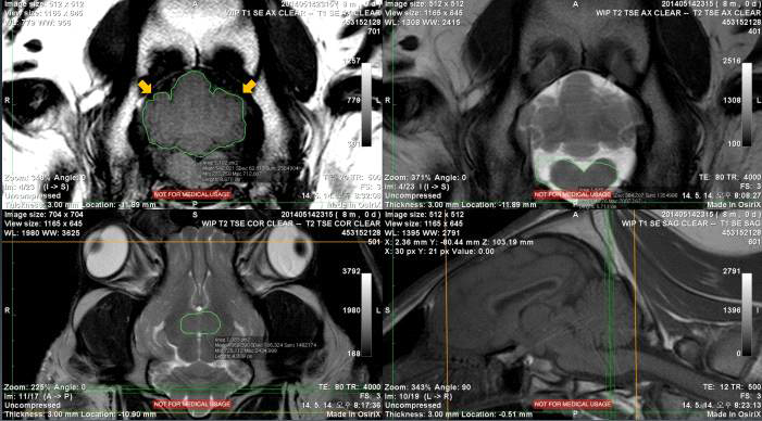 Cerebellum을 세 방향(transverse, dorsal, sagittal)에서 tracing하는 과정의 한 단면