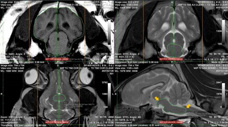 Brainstem을 세 방향(transverse, dorsal, sagittal)에서 tracing하는 과정의 한 단면