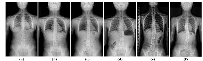 (a) Control group; (b) asymmetry on the left side group; (c) asymmetry on the right side group; (d) scoliosis group; (e) scoliosis wih asymmetry on the left side group; (f) scoliosis with asymmetry on the right side group