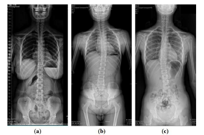 (a) Control group; (b) Scoliosis group 1; (c) Scoliosis group 2
