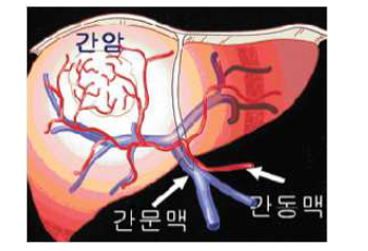 간암 및 영양공급 간 동맥의 모식도