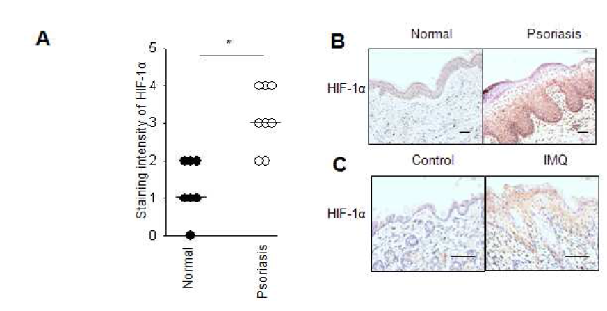 정상 피부 조직과 건선 환자의 피부조직에서의 HIF-1? 발현 비교 및 건선 유발 마우스 피부 조직에서의 HIF-1? 발현 비교