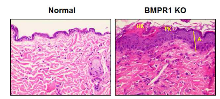 BMP6 억제발현 마우스의 면역염색 시험법 (HK: hyperkeratosis, PK: parakeratosis, A: acanthosis)