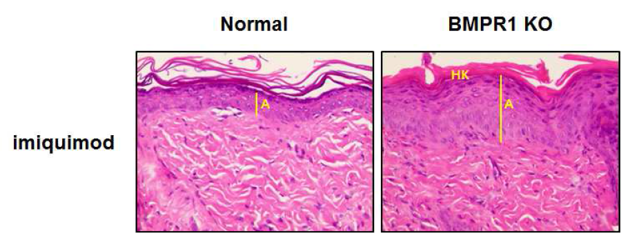 BMP6 억제발현 마우스에 이미퀴모드를 처리하여 건선을 유발 (HK: hyperkeratosis, PK: parakeratosis, A: acanthosis)