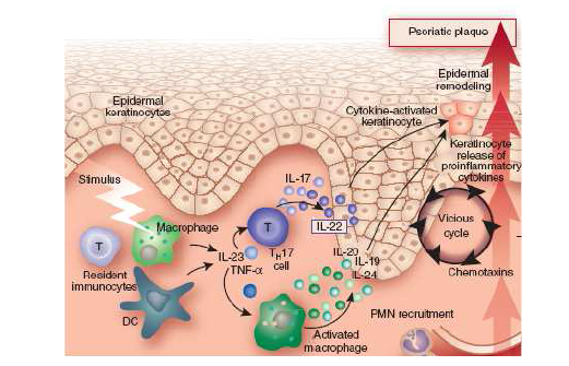 건선에서 피부 각질세포와 면역 세포간에 사이토카인 네트워크 모델에서 IL-17의 중요성을 강조함 (Nickoloff BJ. Nature Medicine