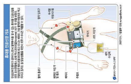 휴대용 인공신장(혈액투석기) 개념 [49]