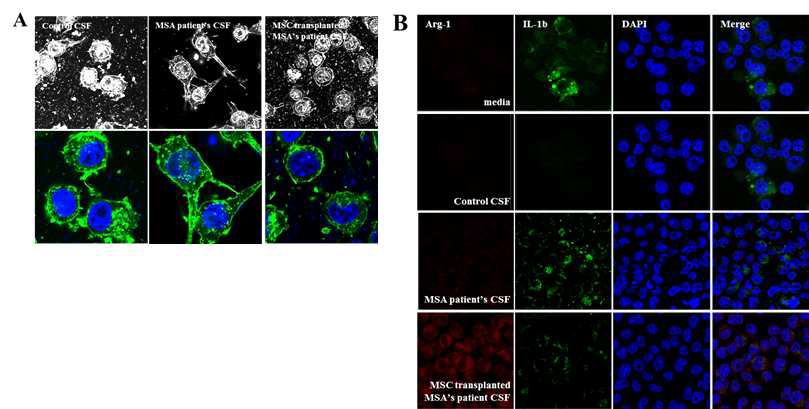 중간엽 줄기세포 투여받은 난치성 파킨슨 질환의 환자 뇌척수액과 반응한 alpha-synuclein 처리한 BV 2 세포의 type 조절