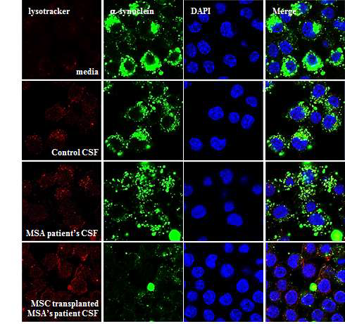 중간엽 줄기세포 투여받은 난치성 파킨슨 질환의 환자 뇌 척수액과 반응한 alpha-synuclein 처리한 BV 2 세포의 라이소좀 활성화 촉진과 alpha-synuclein의 양 조절